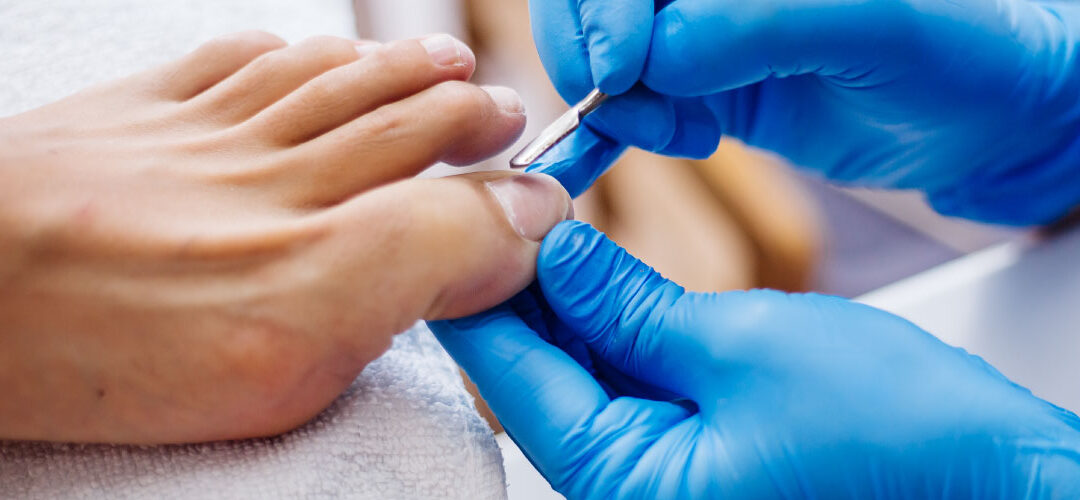 Tratamientos que sí funcionan para los hongos en las uñas (onicomicosis)