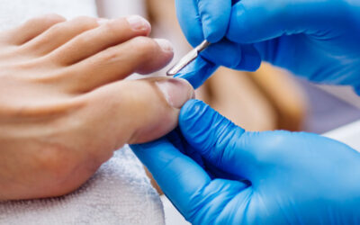 Tratamientos que sí funcionan para los hongos en las uñas (onicomicosis)