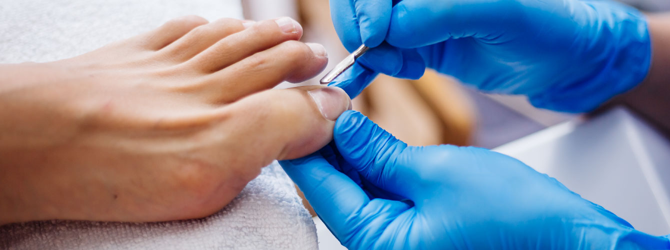 Tratamientos que sí funcionan para los hongos en las uñas (onicomicosis)